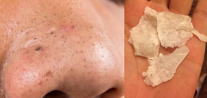Mụn đầu đen chi chít trên mũi cũng trồi lên bằng sạch, không làm to lỗ chân lông nhờ chiếc bàn chải cũ vứt đi