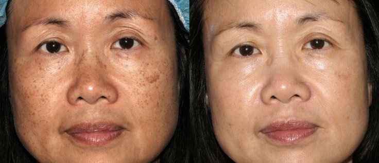 Thử nhiều phương pháp trị nám không thành công nhưng chị em vẫn tìm ra được “chốt” điểm lý tưởng