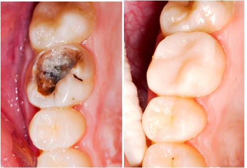 Ngậm thứ này 5 phút, răng lung lay sắp rụng, đau nhức, nhiệt miệng sẽ khỏi ngay tức khắc