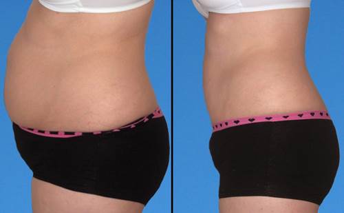 Cứ xoa 2 thứ này lên bụng, đùi... thì mỡ sẽ tan chảy như nước, cân nặng giảm “không phanh” chỉ sau 1 tuần