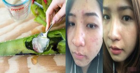 Băm nhuyễn nha đam rồi trộn với muối – Công thức đánh bật mọi loại mụn và thâm sẹo