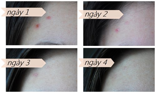 Nguyên liệu thần thánh giúp đánh bay mụn dễ dàng chỉ trong 4 ngày