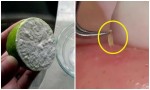 Tuyệt chiêu hô biến mụn ẩn cũng tự trồi lên, dùng nhíp nhổ ra dễ ợt cho mặt căng mịn, láng o như em bé