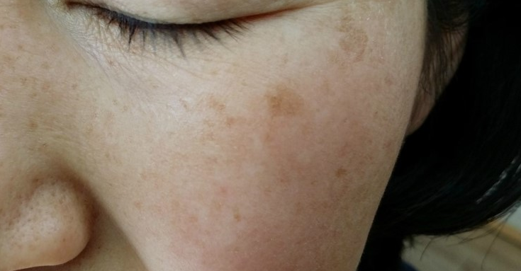 4 VIÊN + BÔI 2 LẦN/Ngày da SẠCH NÁM, trẻ ra 10 tuổi, an toàn, không lo tái phát DỄ NHẤT QUẢ ĐẤT!