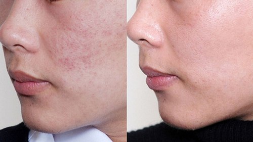 Tạm biệt mụn ẩn, mụn li ti vĩnh viễn bằng 3 cách mà chị em nên biết