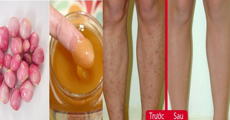 Sẹo lồi, sẹo lõm do ngã xe, trầy xước hay mổ ruột thừa cũng phẳng lì với cách này