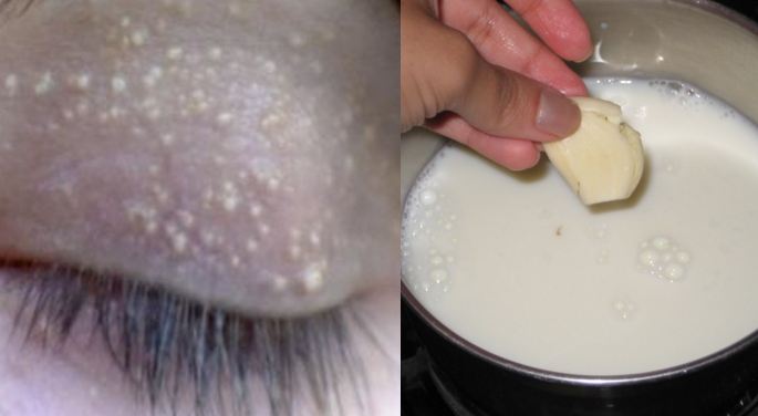 Trị mụn thịt đơn giản, hiệu quả mà không cần tới thẩm mỹ viện để “cà”