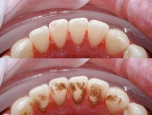 Cao răng bật ngay lập tức chỉ trong 2 phút