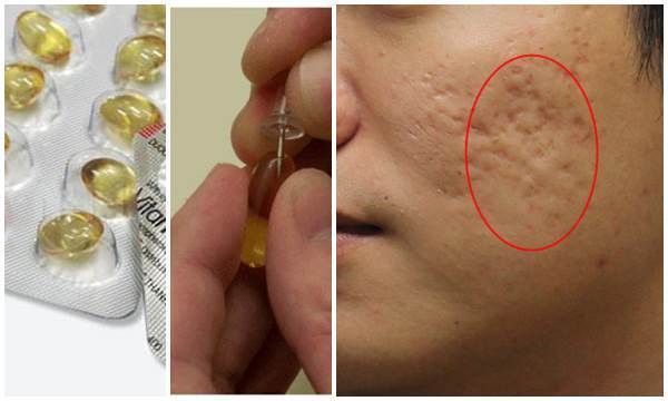 “Lấp đầy” sẹo rỗ lâu năm chỉ nhờ 1 vỉ vitamin E có giá vài chục nghìn, ngại gì không thử?