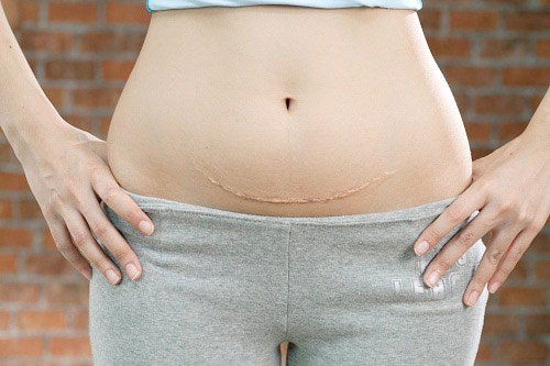 Mẹ làm những cách sau, vết sẹo mổ không còn lồi nữa mà còn đẹp như không nhé!