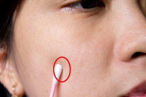Mụn sưng to cỡ nào cũng xẹp sau 1 đêm thoa nước ép tỏi theo cách này, không bỏng rát hay để lại thâm sẹo