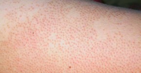 Bôi thứ này lên da, viêm nang lông kinh niên cũng giảm rõ rệt, da mịn như da em bé