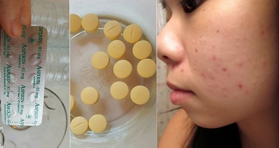 Nghiền nát 3 viên aspirin bôi lên da đúng cách, mặt mụn chi chít cỡ nào cũng biến mất, da căng mọng, trắng sáng không tì vết