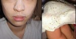 Mụn đầu đen cứng đầu đến mấy cũng phải trồi lên nhờ những thứ này