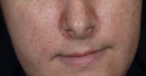 Cách trị nám da bằng trứng gà vừa rẻ, hiệu quả lại an toàn