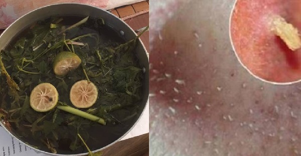 Chỉ nhờ xông hơi mà nhân mụn bị đẩy lên hết, chườm đá nữa thì mặt láng o như chưa từng bị mụn
