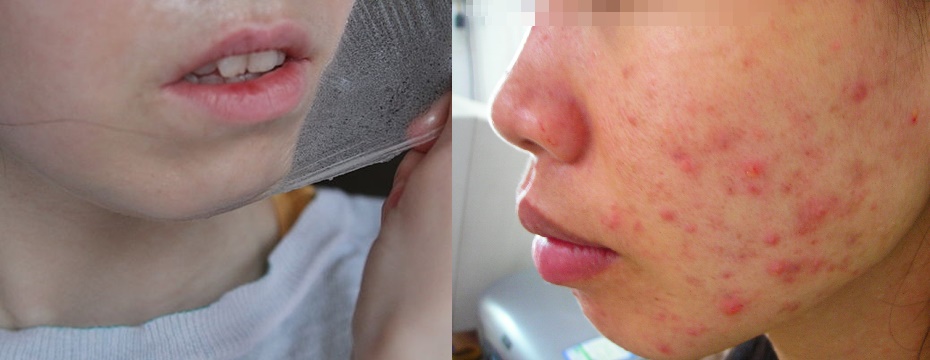 LỖ CHÂN LÔNG “NÁT BÉT” VÌ CỨ GIẬT MIẾNG LỘT MỤN THẾ NÀY ĐÂY