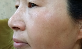 Liệu trình giúp chị em NỘI TRỢ điều trị NÁM DA thành công