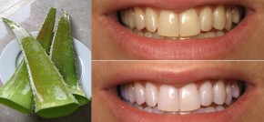 Cắt 1 miếng nha đam rồi chà trong 2 phút, răng trắng bóc như bọc sứ, hết sạch cao răng dù cả năm không đi lấy