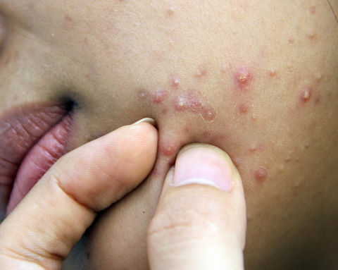 Mụn bao nhiêu cũng hết trong 1 tuần chỉ bằng mẹo không mất tiền