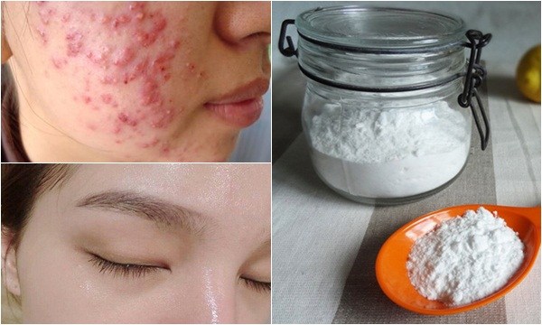Không cần tốn tiền spa, mụn trứng cá hay vết thâm sẹo nặng đến mấy cũng hết nhờ ‘thần dược’ có sẵn trong bếp