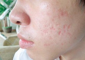 Cách để trị sẹo lõm cực dễ mà bạn chưa phát hiện ra