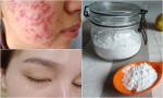 Không cần tốn tiền spa, mụn trứng cá hay vết thâm sẹo nặng đến mấy cũng hết nhờ ‘thần dược’ có sẵn trong bếp