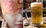 “Phát hoảng” với 3 cách trị mụn, dưỡng da trắng bật 2 tông chỉ từ 1 cốc bia mà không cần dùng 1 giọt mỹ phẩm nào