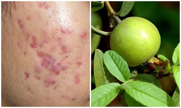 Thâm mụn đầy mặt không còn dù chỉ 1 nốt chỉ sau vài ngày nhờ bôi thứ này