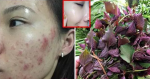 Bí quyết trị tận gốc các loại mụn và vết thâm chỉ nhờ 1 nắm lá tía tô