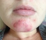 Tất tần tật những điều cần biết về mụn trứng cá và bí kíp xóa sổ chúng trong 1 nốt nhạc