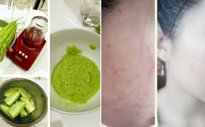 Ba cách đơn giản giúp nàng trị dứt điểm lũ mụn ẩn cứng đầu đáng ghét