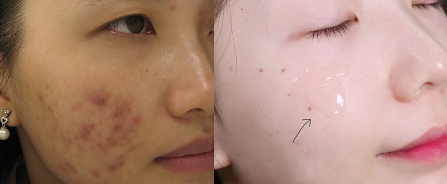 Nặn mụn không để lại thâm, da lại căng mịn trắng sáng nhờ làm điều này