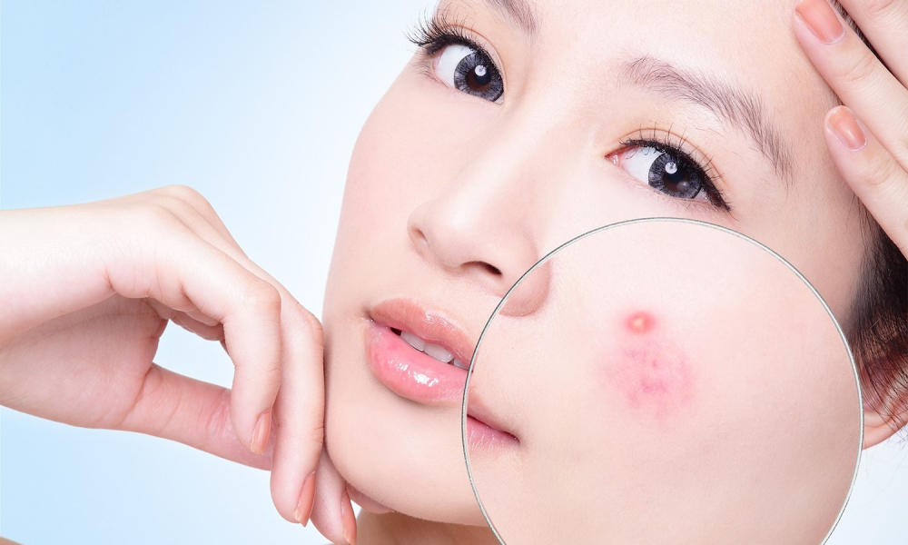 Da hết hẳn mụn bọc sau 3 ngày, trắng xinh trở lại và được chồng yêu hơn chỉ nhờ bia tươi