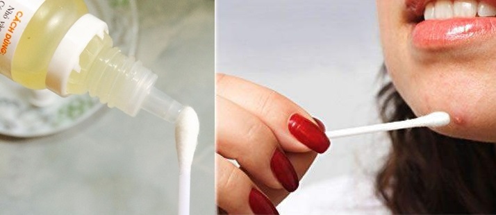Thoa 3 giọt thuốc nhỏ mắt lên mụn trứng cá, cô gái “hốt hoảng” khi nhận một cái kết bất ngờ