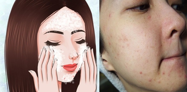 Nguyên nhân và cách triệt hạ tận gốc các nốt mụn đáng ghét