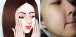 Nguyên nhân và cách triệt hạ tận gốc các nốt mụn đáng ghét