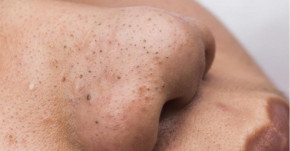 Thử ngay các cách trị mụn đầu đen bằng mật ong hiệu quả được rất nhiều người áp dụng