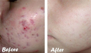 Bỏ ra 5 - 10 phút dùng 1 nhúm muối, da trắng mịn, sạch khỏe và hết thâm mụn tức thì
