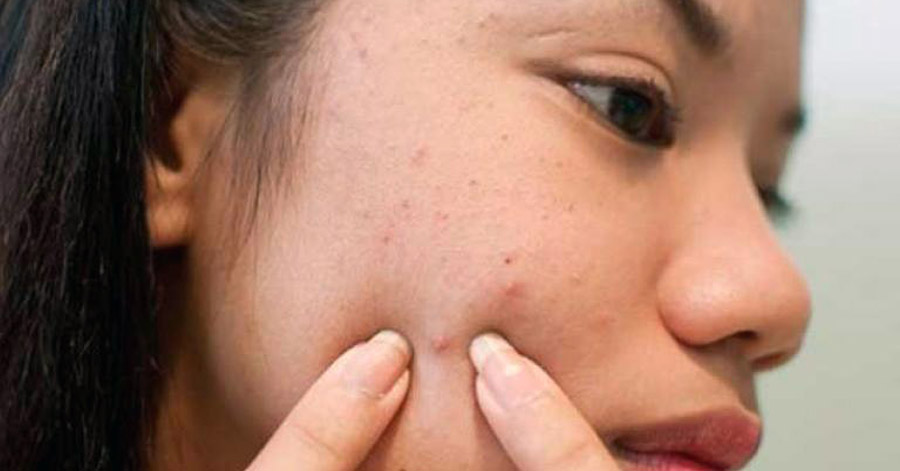 5 thói quen ai cũng làm hàng ngày nhưng đây là nguyên nhân khiến mụn “nở như hoa” chữa mãi không khỏi