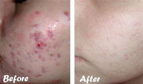 Bỏ ra 5 - 10 phút dùng 1 nhúm muối, da trắng mịn, sạch khỏe và hết thâm mụn tức thì