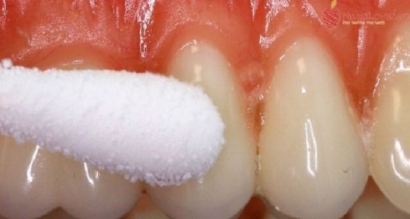 Tuyệt chiêu chữa “đau nhức răng” chỉ trong tích tắc ngay tại nhà!