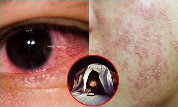 Hội “cày phim” coi chừng 4 điều này nếu không muốn da vừa nổi mụn chi chít, hỏng vừa mắt lại hại thân
