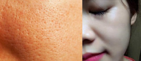Chi tiết cách chữa lỗ chân lông to và thâm đen chỉ sau 3 ngày