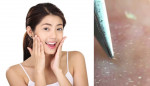 Bí kíp làm mụn tự trồi lên, dùng nhíp gắp ra là mặt láng o