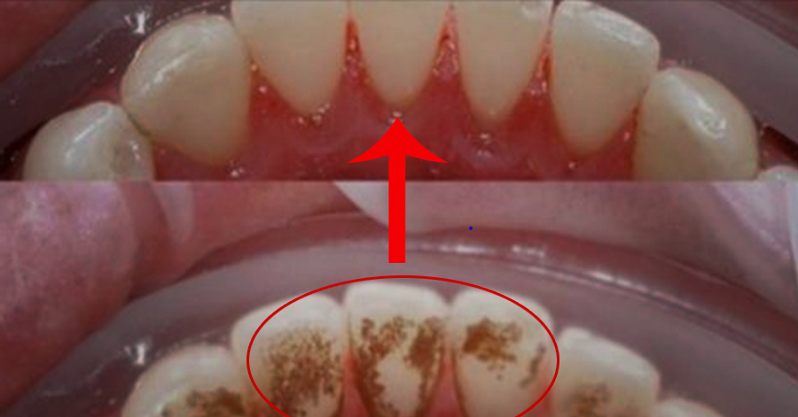 Ngậm thứ này trước khi đi ngủ, cao răng bật ra từng mảng ngay vào sáng ngày hôm sau