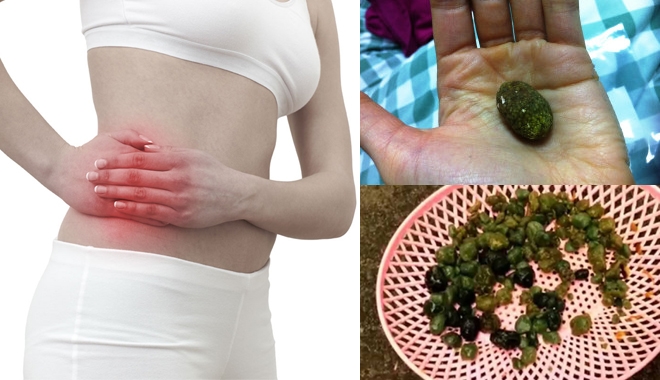 Bị sỏi gan 1 tuần không kịp chữa trị cũng đủ khiến bạn "chầu Diêm Vương"