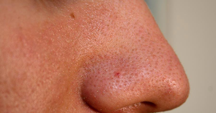 Trị sạch mụn đầu đen chỉ sau 10 phút bôi kem đánh răng lên mũi