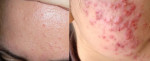 Nhân diện đúng 8 LOẠI MỤN để điều trị "trăm trận trăm thắng"