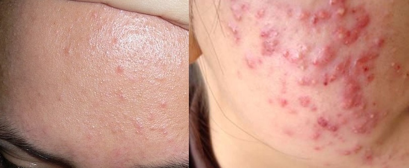 Nhân diện đúng 8 LOẠI MỤN để điều trị "trăm trận trăm thắng"